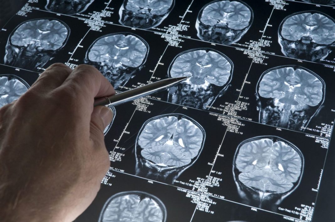 cerebro